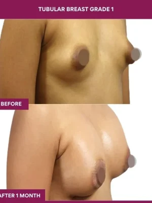 tubular-breast-correction-before-after-results-mumbai-india-patient01-side-right